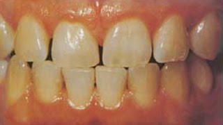 yellowteeth